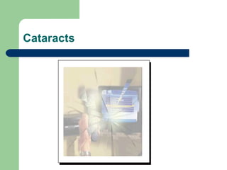 Cataracts 