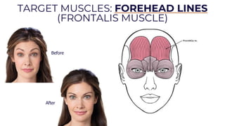Foundation Botox Training in Aesthetics Injections | PDF