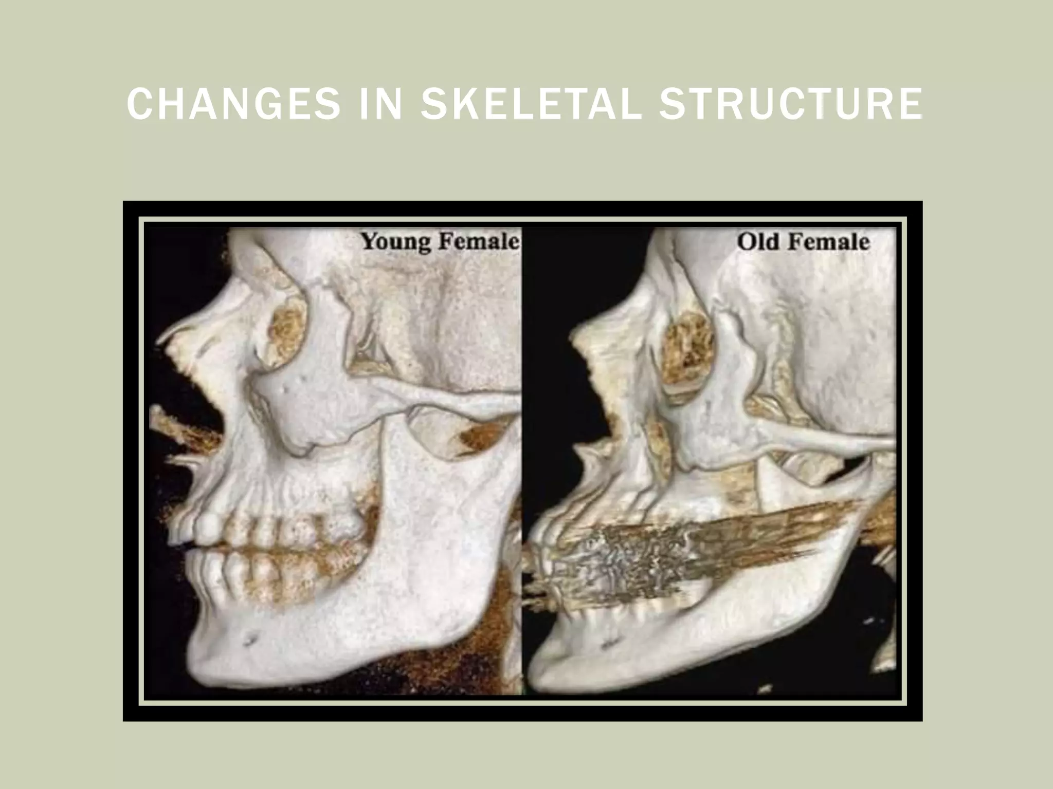 CHANGES IN SKELETAL STRUCTURE
 