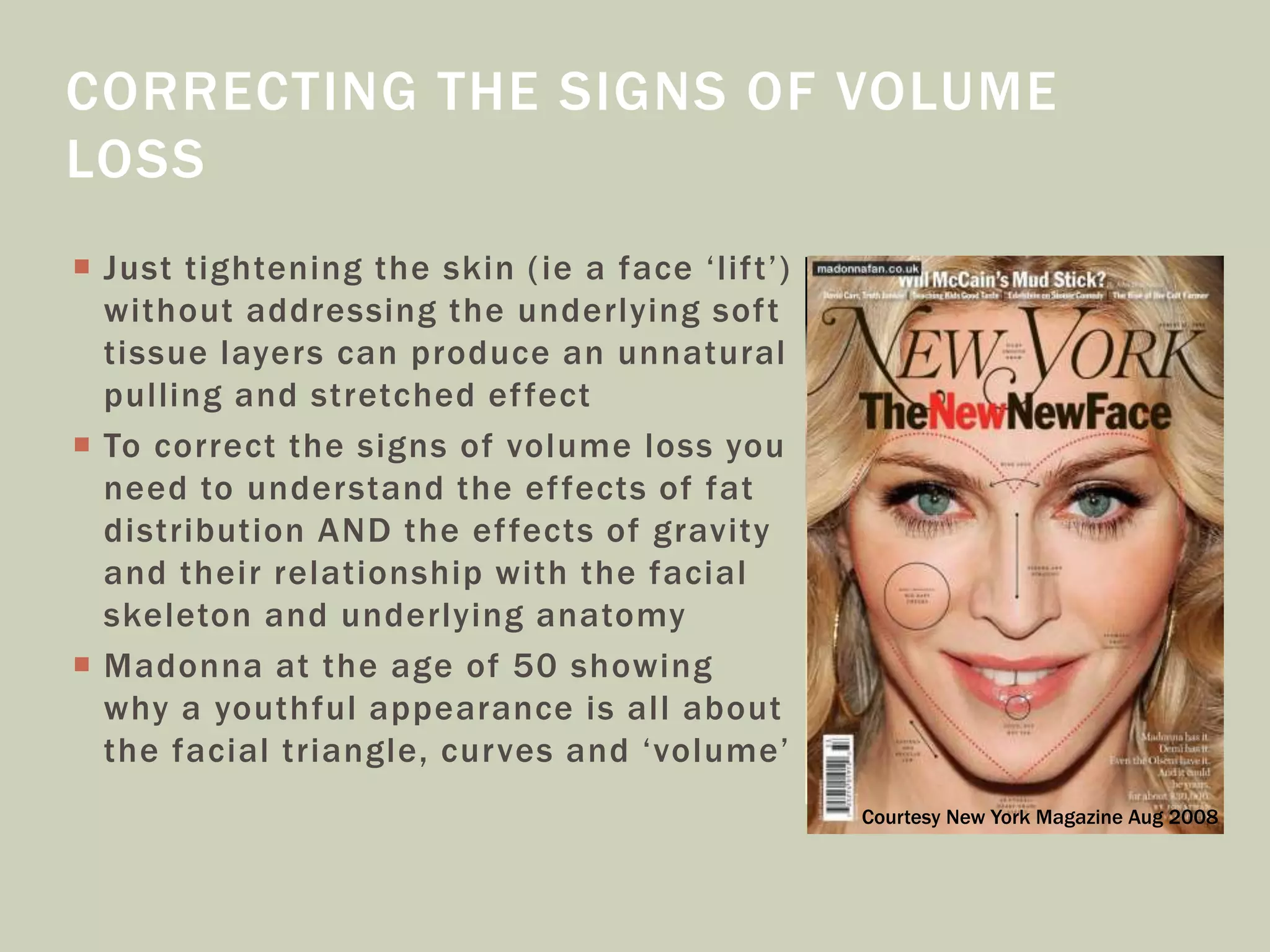  Just tightening the skin (ie a face ‘lift’)
without addressing the underlying soft
tissue layers can produce an unnatural
pulling and stretched effect
 To correct the signs of volume loss you
need to understand the effects of fat
distribution AND the effects of gravity
and their relationship with the facial
skeleton and underlying anatomy
 Madonna at the age of 50 showing
why a youthful appearance is all about
the facial triangle, curves and ‘volume’
CORRECTING THE SIGNS OF VOLUME
LOSS
Courtesy New York Magazine Aug 2008
 