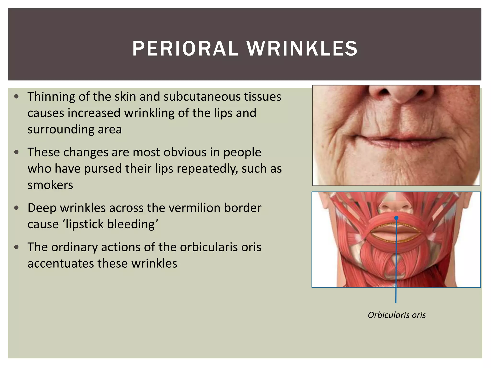 Orbicularis oris
• Thinning of the skin and subcutaneous tissues
causes increased wrinkling of the lips and
surrounding area
• These changes are most obvious in people
who have pursed their lips repeatedly, such as
smokers
• Deep wrinkles across the vermilion border
cause ‘lipstick bleeding’
• The ordinary actions of the orbicularis oris
accentuates these wrinkles
PERIORAL WRINKLES
 