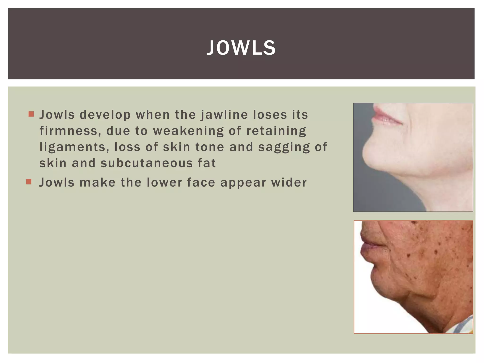  Jowls develop when the jawline loses its
firmness, due to weakening of retaining
ligaments, loss of skin tone and sagging of
skin and subcutaneous fat
 Jowls make the lower face appear wider
JOWLS
 