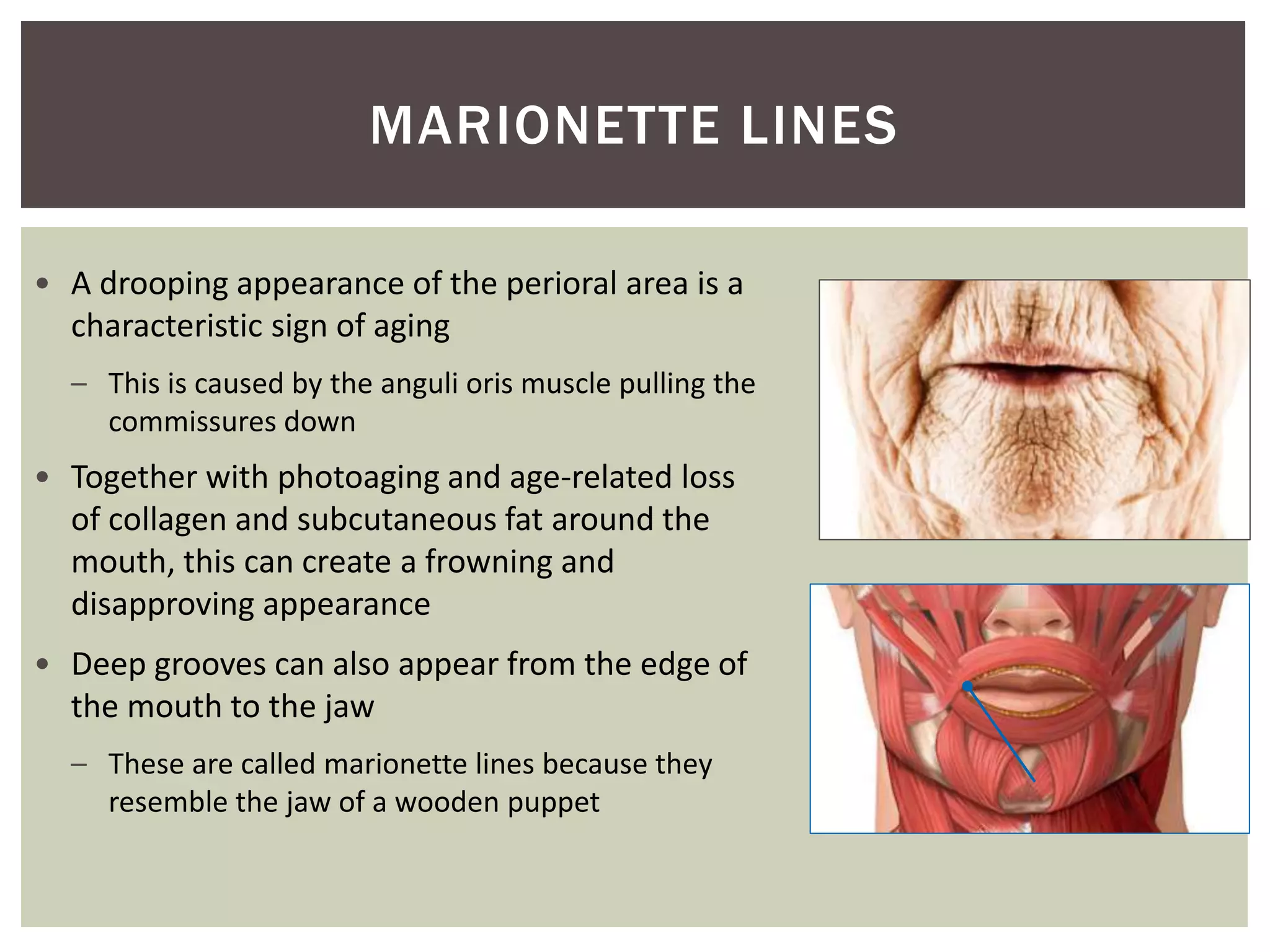 Depressor anguli oris
• A drooping appearance of the perioral area is a
characteristic sign of aging
– This is caused by the anguli oris muscle pulling the
commissures down
• Together with photoaging and age-related loss
of collagen and subcutaneous fat around the
mouth, this can create a frowning and
disapproving appearance
• Deep grooves can also appear from the edge of
the mouth to the jaw
– These are called marionette lines because they
resemble the jaw of a wooden puppet
MARIONETTE LINES
 