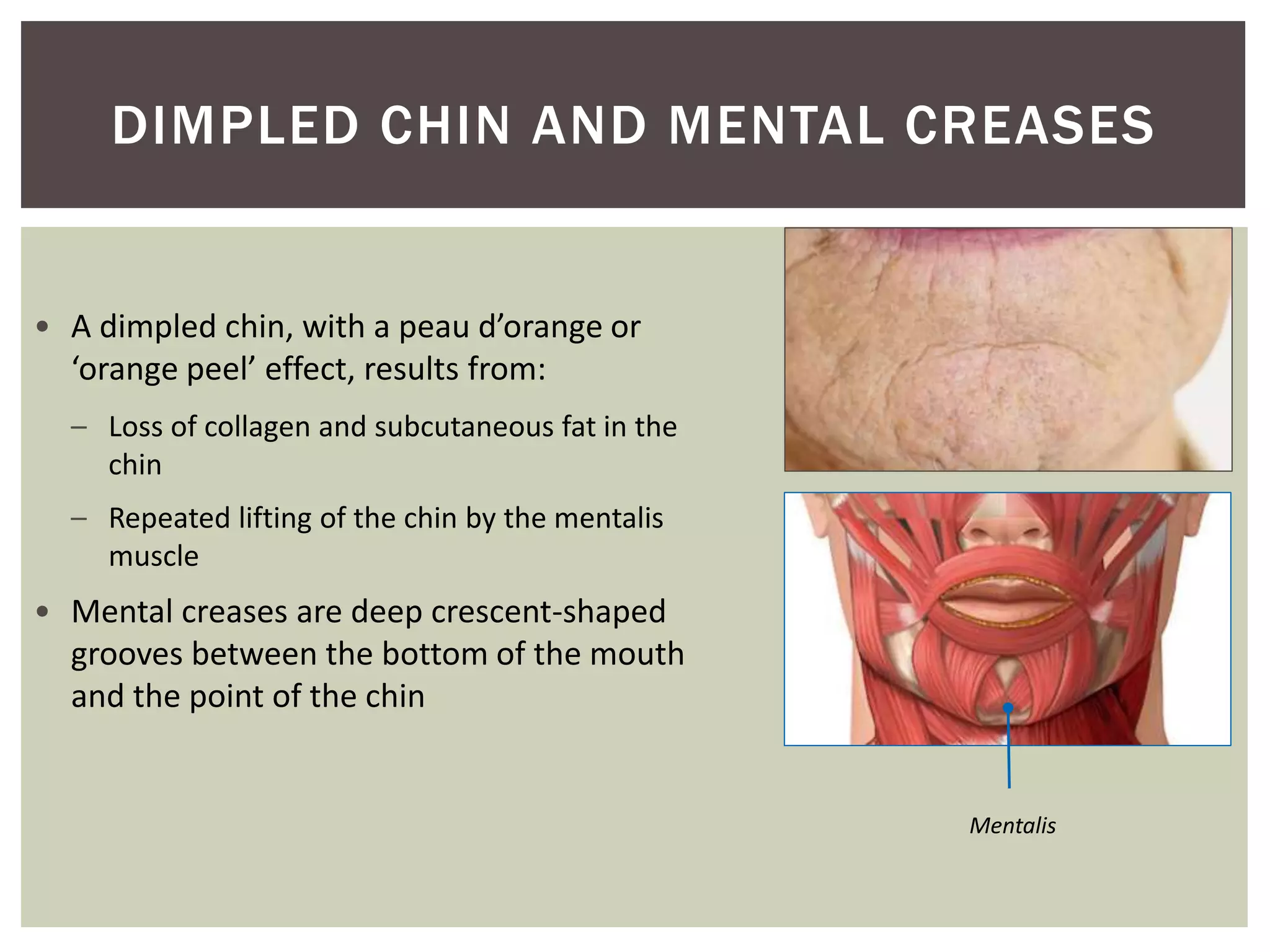 • A dimpled chin, with a peau d’orange or
‘orange peel’ effect, results from:
– Loss of collagen and subcutaneous fat in the
chin
– Repeated lifting of the chin by the mentalis
muscle
• Mental creases are deep crescent-shaped
grooves between the bottom of the mouth
and the point of the chin
Mentalis
DIMPLED CHIN AND MENTAL CREASES
 