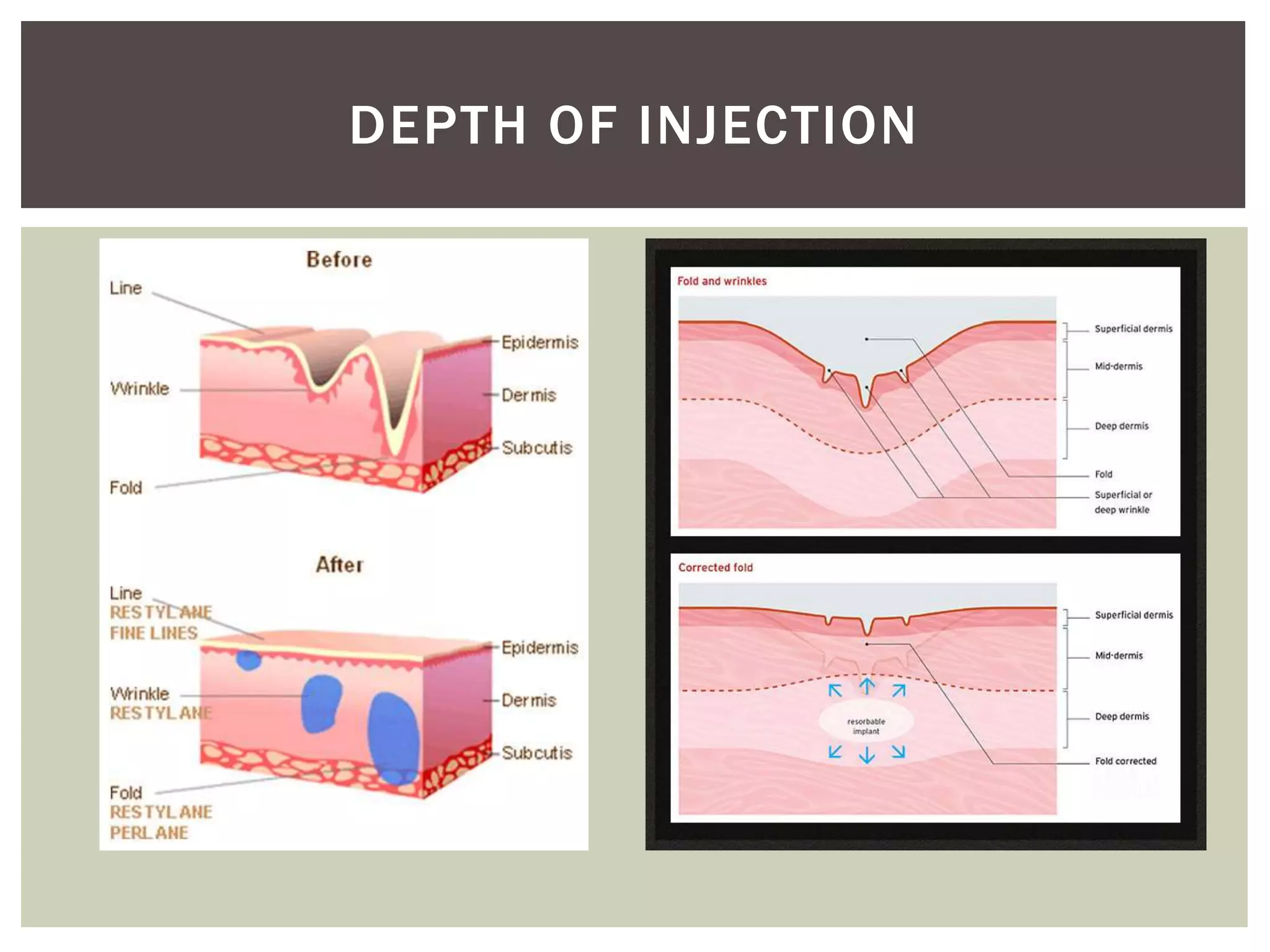 DEPTH OF INJECTION
 
