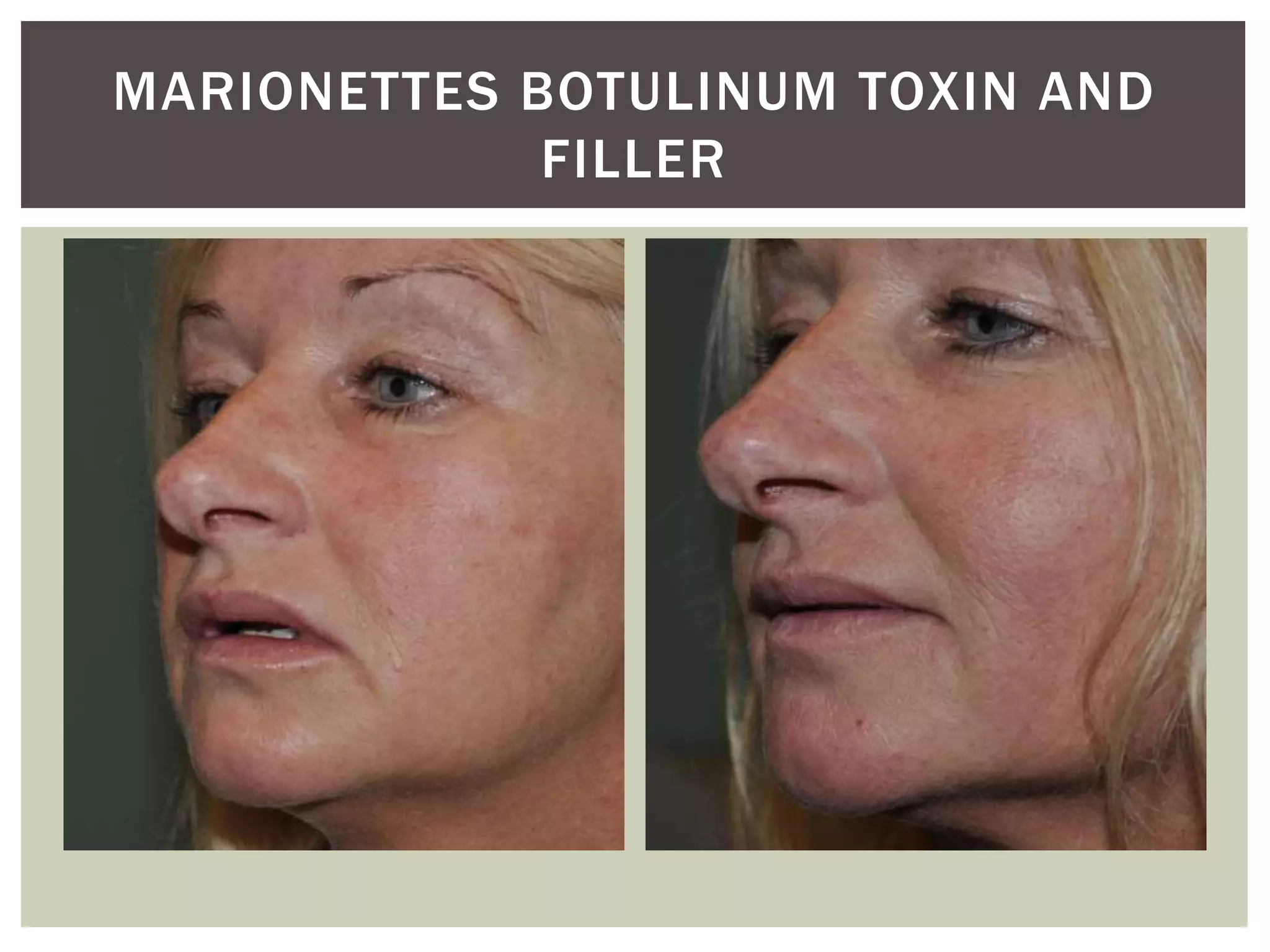 MARIONETTES BOTULINUM TOXIN AND
FILLER
 