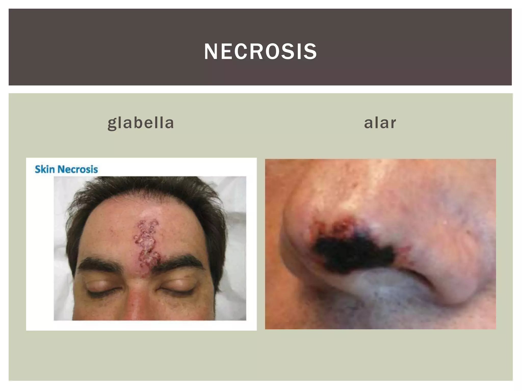 glabella alar
NECROSIS
 