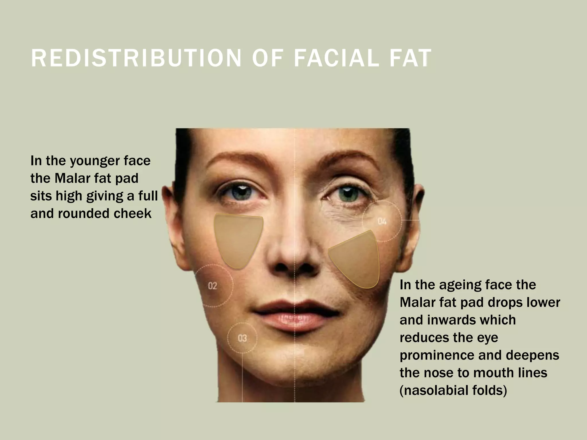 REDISTRIBUTION OF FACIAL FAT
In the younger face
the Malar fat pad
sits high giving a full
and rounded cheek
In the ageing face the
Malar fat pad drops lower
and inwards which
reduces the eye
prominence and deepens
the nose to mouth lines
(nasolabial folds)
 