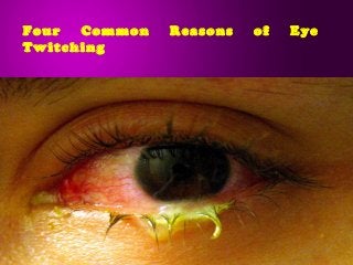 Four Common Reasons of Eye
Twitching
 