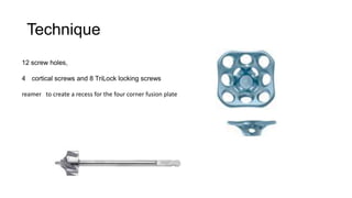 Technique
12 screw holes,
4 cortical screws and 8 TriLock locking screws
reamer to create a recess for the four corner fusion plate

 