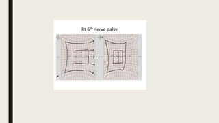 Fourth and sixth cranial nerve palsies | PDF