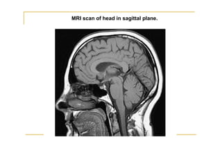 MRI scan of head in sagittal plane.
 