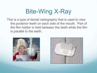 Bite-Wing X-Ray
This is a type of dental radiography that is used to view
  the posterior teeth on each side of the mouth. Part of
  the film holder is held between the teeth while the film
  is parallel to the teeth.
 