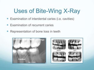 Uses of Bite-Wing X-Ray
 Examination of interdental caries (i.e. cavities)
 Examination of recurrent caries
 Representation of bone loss in teeth
 