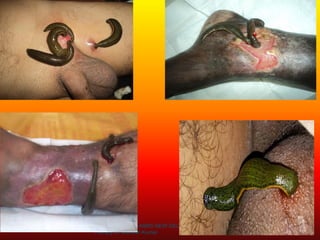 ENDOSURG-2019 AIIMS NEW DELHI – Leech
Therapy Dr Mahesh Kumar 7
 