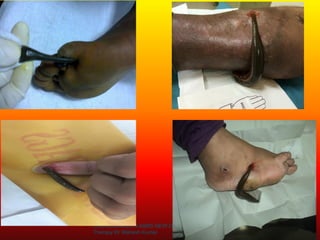 ENDOSURG-2019 AIIMS NEW DELHI – Leech
Therapy Dr Mahesh Kumar 8
 