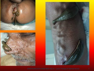 ENDOSURG-2019 AIIMS NEW DELHI – Leech Therapy Dr Mahesh Kumar 9
 
