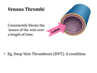 Venous Thrombi
:
• Eg. Deep Vein Thrombosis (DVT): A condition
Consistently blocks the
lumen of the vein over
a length of time.
 