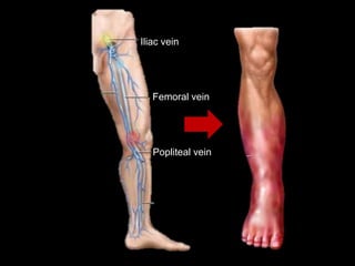Femoral vein
Popliteal vein
Iliac vein
 