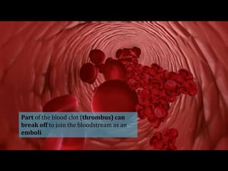 Part of the blood clot (thrombus) can
break off to join the bloodstream as an
emboli
 