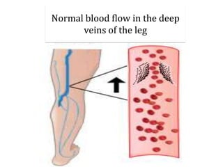 Normal blood flow in the deep
veins of the leg
 