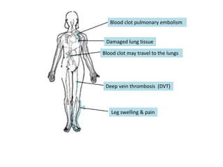 Blood clot pulmonary embolism
Damaged lung tissue
Blood clot may travel to the lungs
Deep vein thrombosis (DVT)
Leg swelling & pain
 