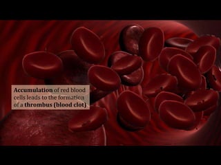 Accumulation of red blood
cells leads to the formation
of a thrombus (blood clot)
 