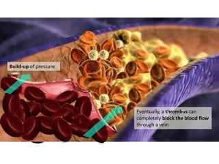Eventually, a thrombus can
completely block the blood flow
through a vein
Build-up of pressure
 
