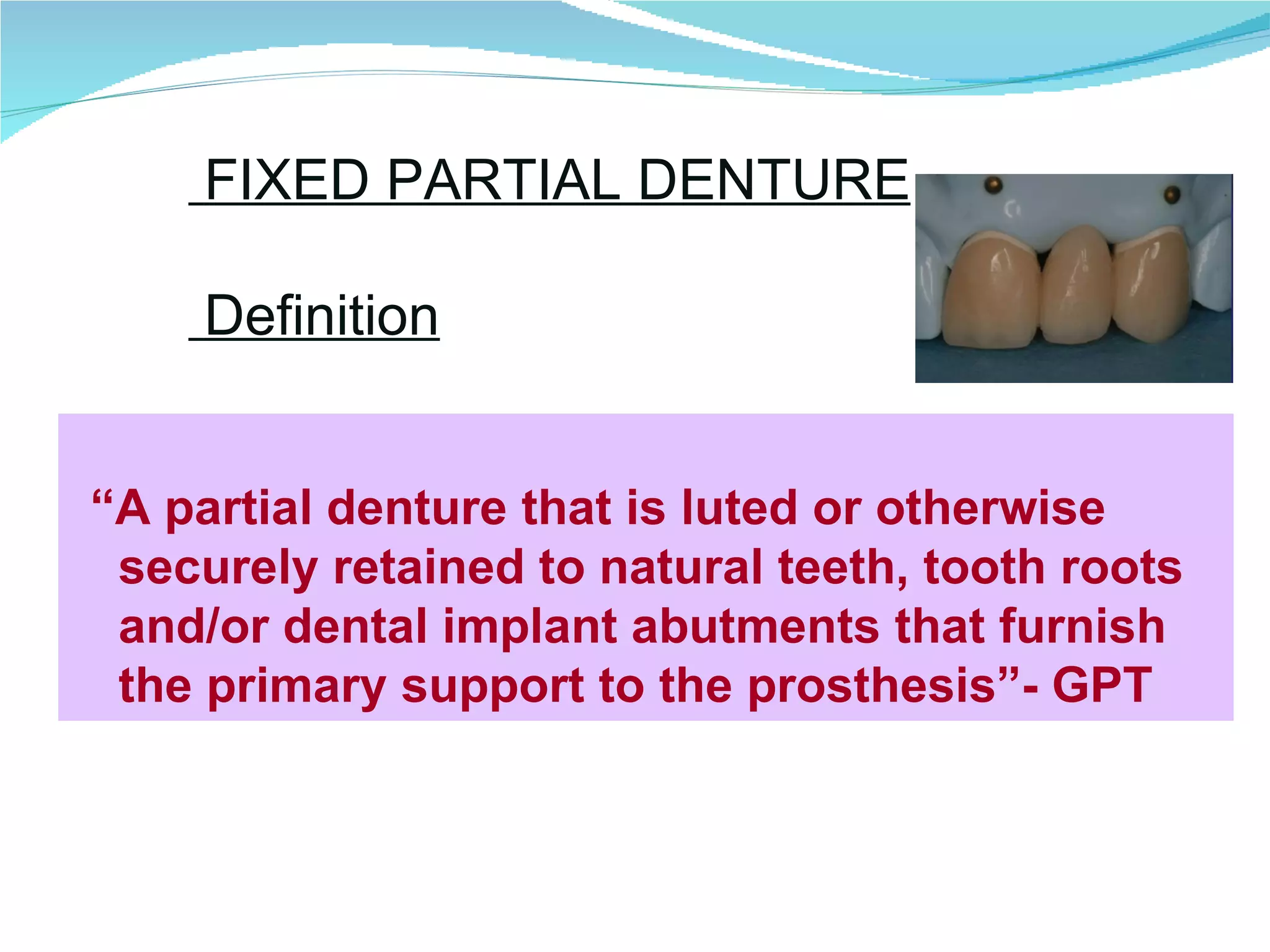 Introduction to fixed partial denture