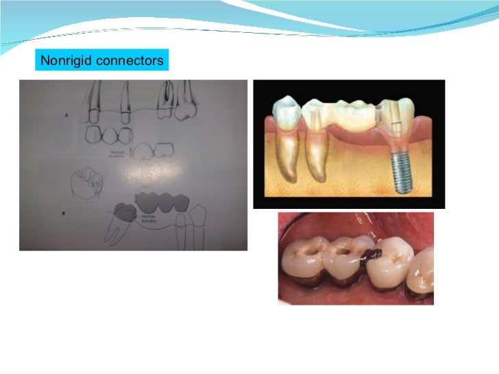Introduction to fixed partial denture