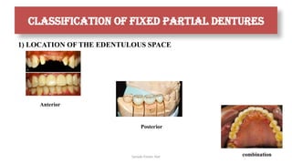 Sample Footer Text
CLASSIFICATION OF FIXED PARTIAL DENTURES
1) LOCATION OF THE EDENTULOUS SPACE
Posterior
Anterior
combination
 