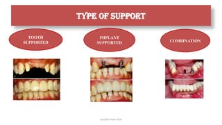 Sample Footer Text
Type of support
TOOTH
SUPPORTED
IMPLANT
SUPPORTED COMBINATION
 