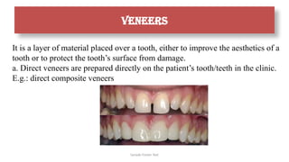 Sample Footer Text
It is a layer of material placed over a tooth, either to improve the aesthetics of a
tooth or to protect the tooth’s surface from damage.
a. Direct veneers are prepared directly on the patient’s tooth/teeth in the clinic.
E.g.: direct composite veneers
veneers
 