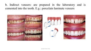 Sample Footer Text
b. Indirect veneers: are prepared in the laboratory and is
cemented into the tooth. E.g.: porcelain laminate veneers
 
