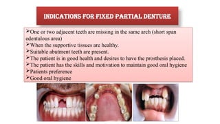 Sample Footer Text
Indications for fixed partial denture
One or two adjacent teeth are missing in the same arch (short span
edentulous area)
When the supportive tissues are healthy.
Suitable abutment teeth are present.
The patient is in good health and desires to have the prosthesis placed.
The patient has the skills and motivation to maintain good oral hygiene
Patients preference
Good oral hygiene
 
