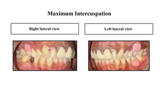 FPD ppt fixed partial denture case presentation format | PPTX