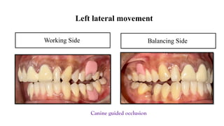 FPD ppt fixed partial denture case presentation format | PPTX