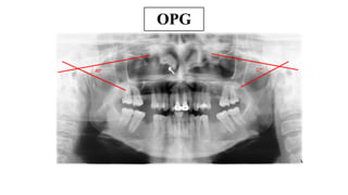 FPD ppt fixed partial denture case presentation format | PPTX