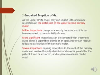 2- Impaired Eruption of 6s:
As the upper FPMs erupt, they can impact into, and cause
resorption of, the distal root of the upper second primary
molar.
Milder impactions can spontaneously improve, and this has
been reported to occur in 66% of cases.
More significant impactions can be corrected with treatment
using either a separating elastic or an appliance or can resolve
following exfoliation of the primary molar.
Severe impactions causing resorption to the root of the primary
molar can involve the pulp chamber and may be painful for the
patient, E can be extracted, and a space maintainer can be
used.
 
