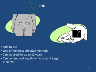 IUD




•Safe to use
•One of the most effective methods
•Can be used for up to 12 years
•Can be removed any time if you want to get
 pregnant

                                              22
 