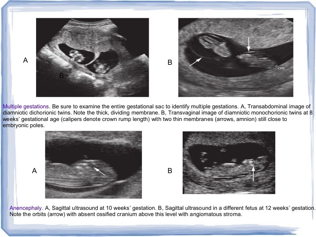 first trimester ultrasound and overview of obs imaging