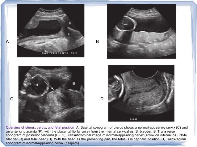 first trimester ultrasound and overview of obs imaging