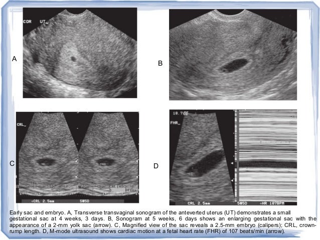 When do you have dating ultrasound