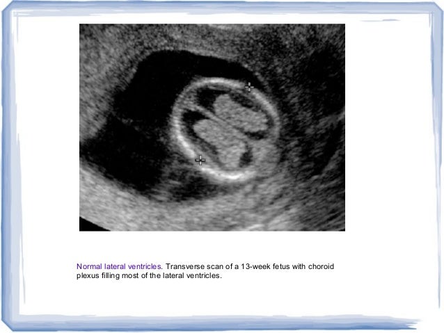 first trimester ultrasound and overview of obs imaging