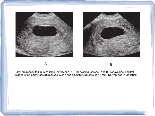 Empty sac tilted uterus ultrasound concerned about