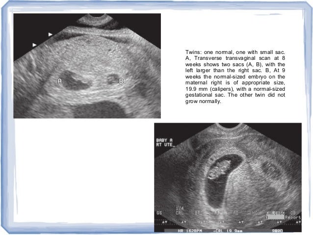 trimester obs yolk transvaginal