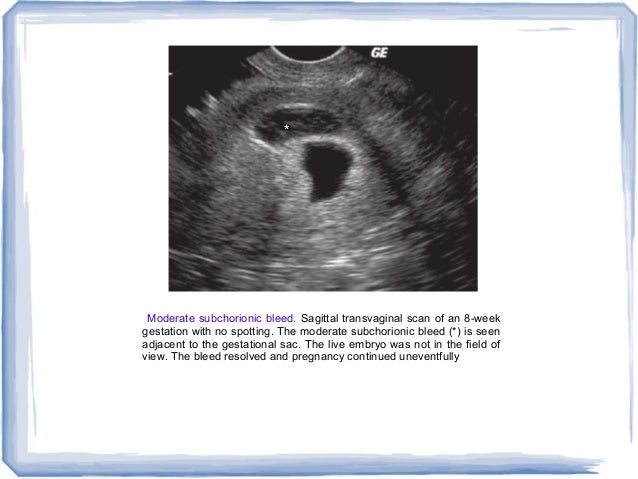 First Trimester Ultrasound And Overview Of Obs Imaging