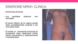 SÍNDROME MRKH: CLÍNICA
• Amenorrea primaria.
• Los genitales externos son
normales.
• El tercio inferior de la vagina puede
estar completamente ausente o ser
una bolsa corta.
• Si existe un remanente funcional se
presentará dolor abdominal cíclico
severo secundaria a criptomenorrea
y hematometra.
 