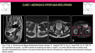 Fig. 4: Fig. 4: Síndrome de Mayer-Rokitansky-Küster-Hauser. A . Sagital FSE T2. B y C. Axial FSE T2. D. FSE T2
con supresión de grasa . La RM muestra la ausencia de útero y vagina. La uretra (flecha blanca sólida) está
situada inmediatamente anterior a la pared rectal (flecha blanca transparente). Agenesia renal izquierda (triángulo
blanco sólido).
 