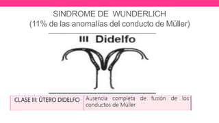 SINDROME DE WUNDERLICH
(11% de las anomalías del conducto de Müller)
 